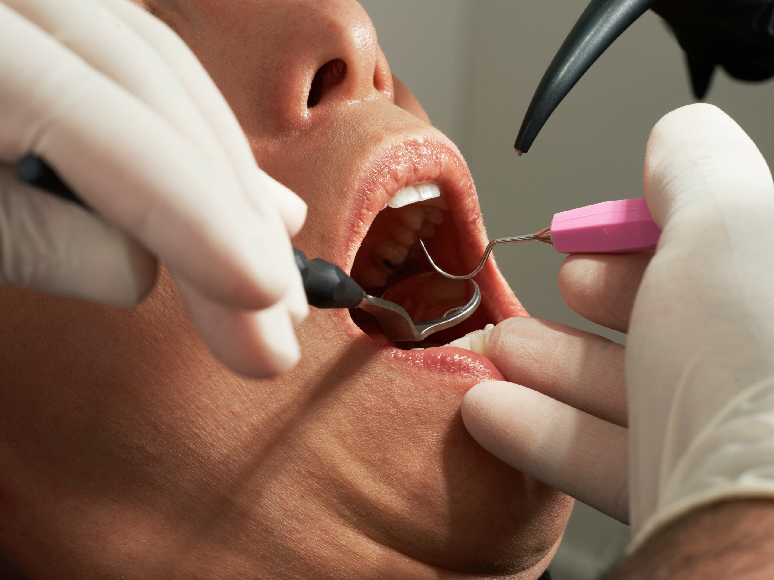 A dental procedure in progress, illustrating how ancillary benefits like dental coverage enhance Florida group health insurance packages.